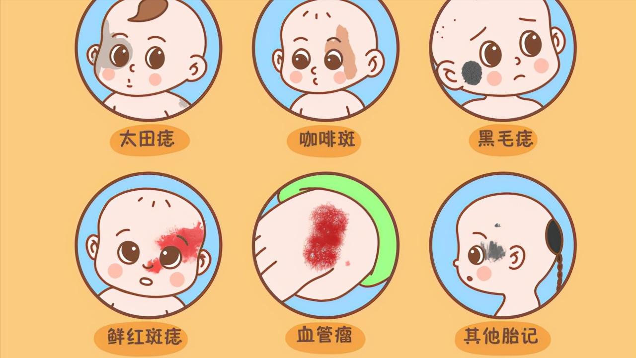 普萘洛尔可以用来治疗血管瘤吗,普萘洛尔治疗血管瘤的注意事项