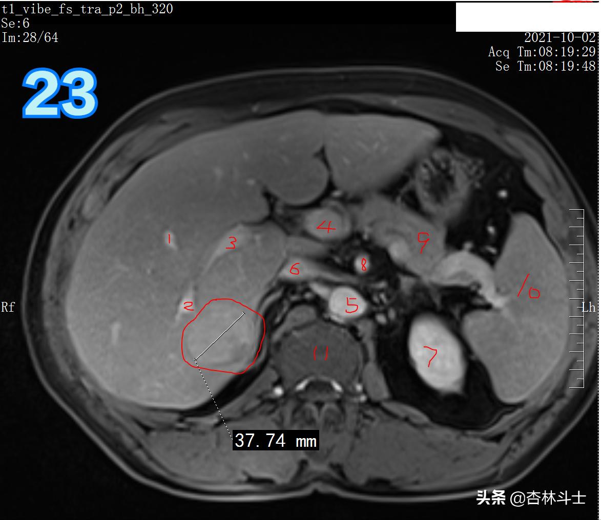 肝癌8公分肿瘤能活多久,肝癌细胞最大长多大