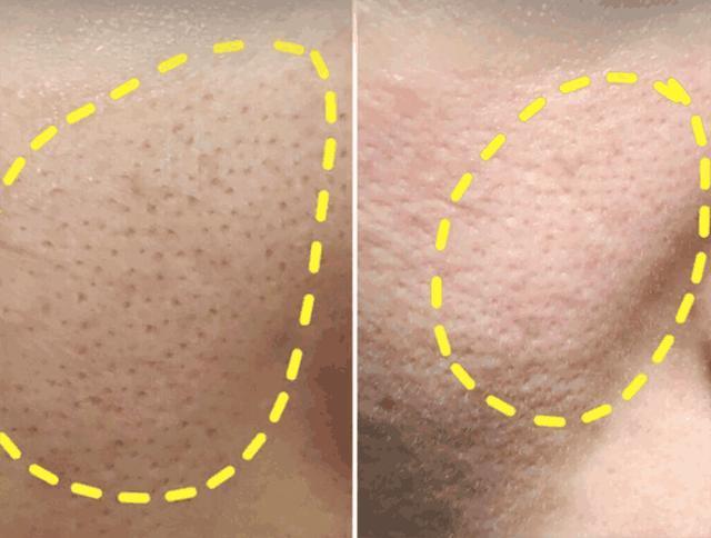 毛孔大得像“筛子”，你的毛孔是怎么一步步撑大的？