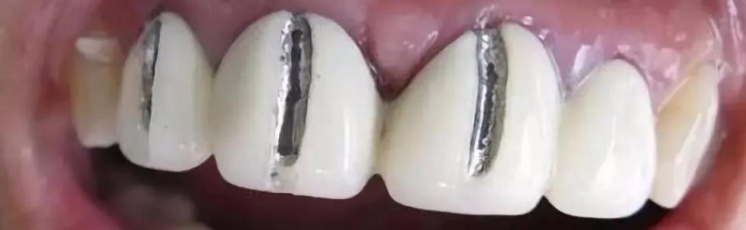 缺牙后哪种补牙性价比高,缺牙想补牙去哪里比较划算