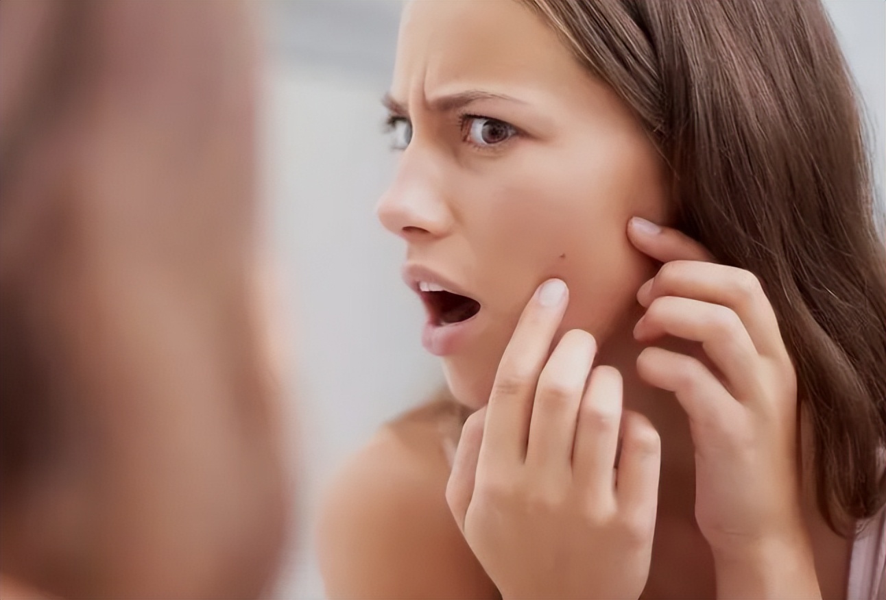 女性一来例假就会“爆痘”？如何改善姨妈痘的情况？了解无坏处