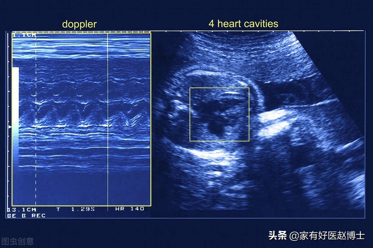 多瓣膜轻度反流左室舒张功能减退,彩超心脏左室舒张功能减退严重吗