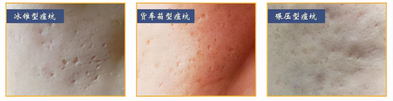 plasma和点阵激光祛痘坑哪个好,点阵激光仪去痘坑前后对比