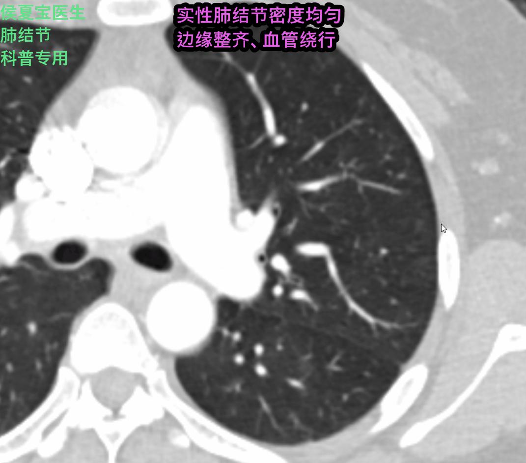 这例“被肺癌”的结节，手术不过度，但完全可以延迟在疫情后