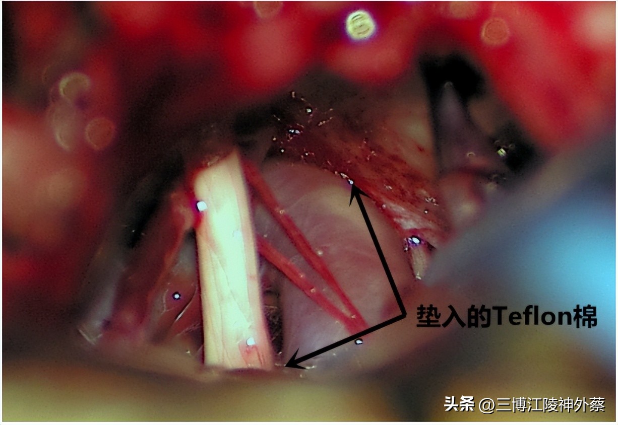 双侧面肌痉挛真实案例,面肌痉挛会发展成三叉神经痛吗