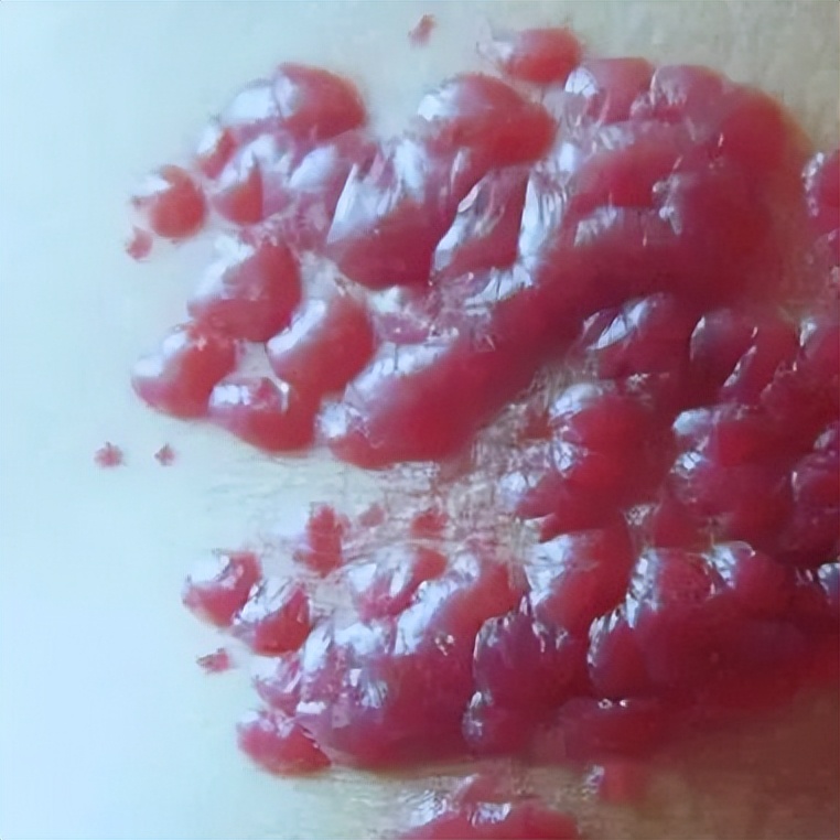 新生儿有胎记怎么办,新生儿有胎记是怎么造成的