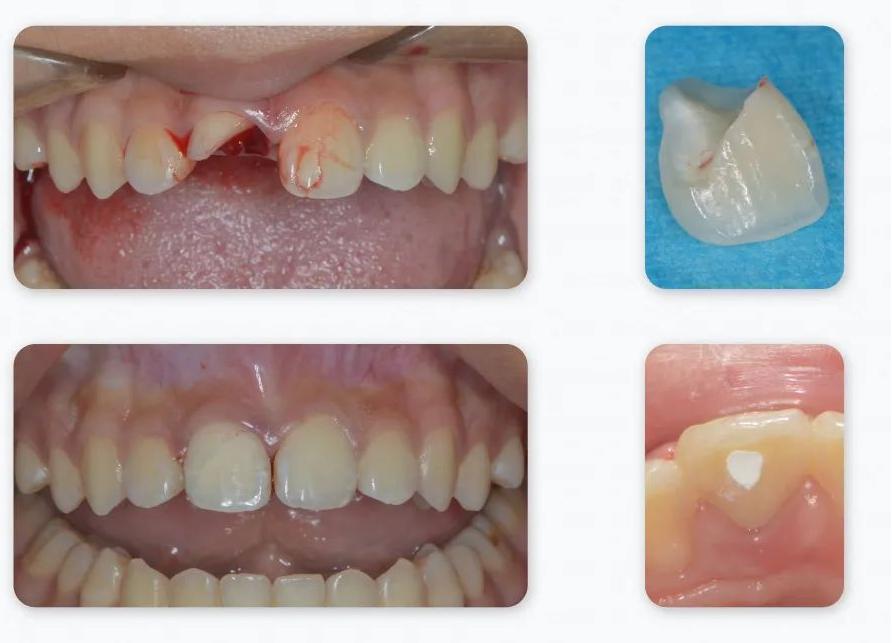 摔掉牙齿怎么补救,摔了一跤牙怎么快速牢固