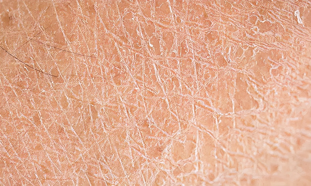 皮肤干燥刺痛用什么护肤品,脱皮刺痛泛红用什么护肤品