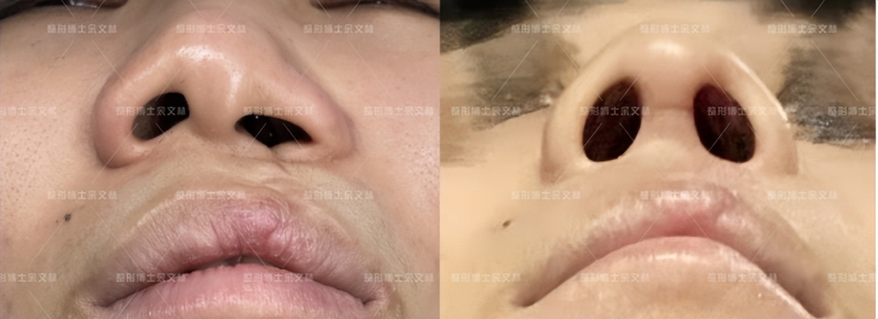 唇裂继发鼻畸形修复,唇裂手术后鼻孔塌陷怎么矫正
