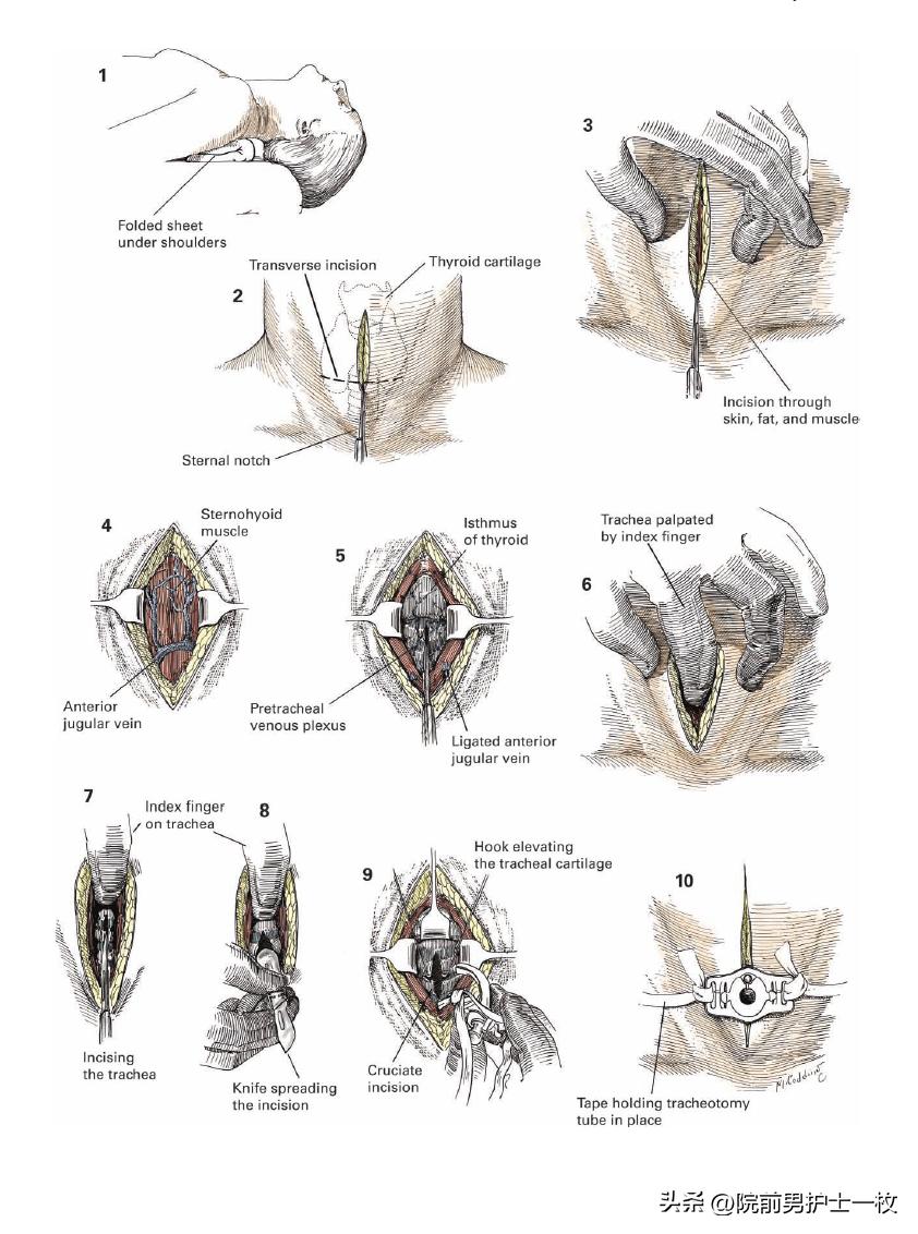关于气管切开技术流程及注意事项