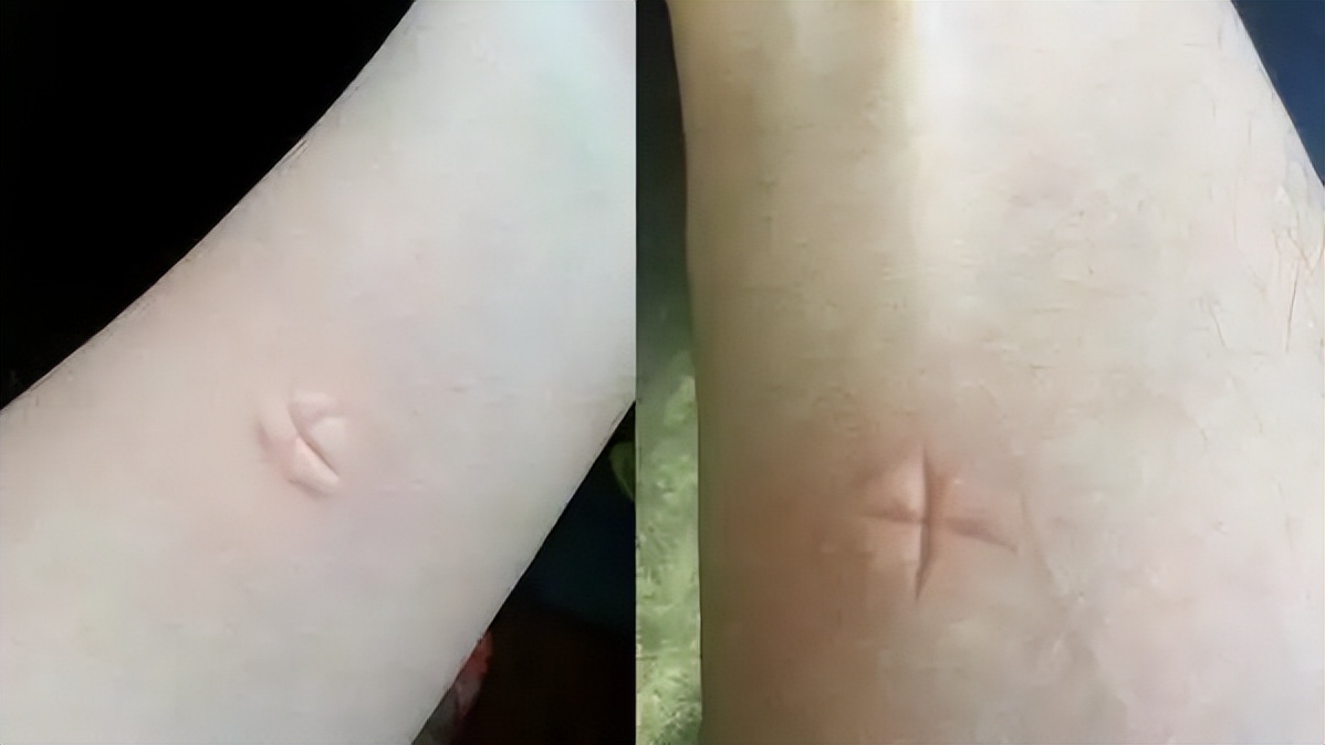 被蚊虫咬了一直反复痒如何处理,为什么被蚊虫咬了会红肿起泡