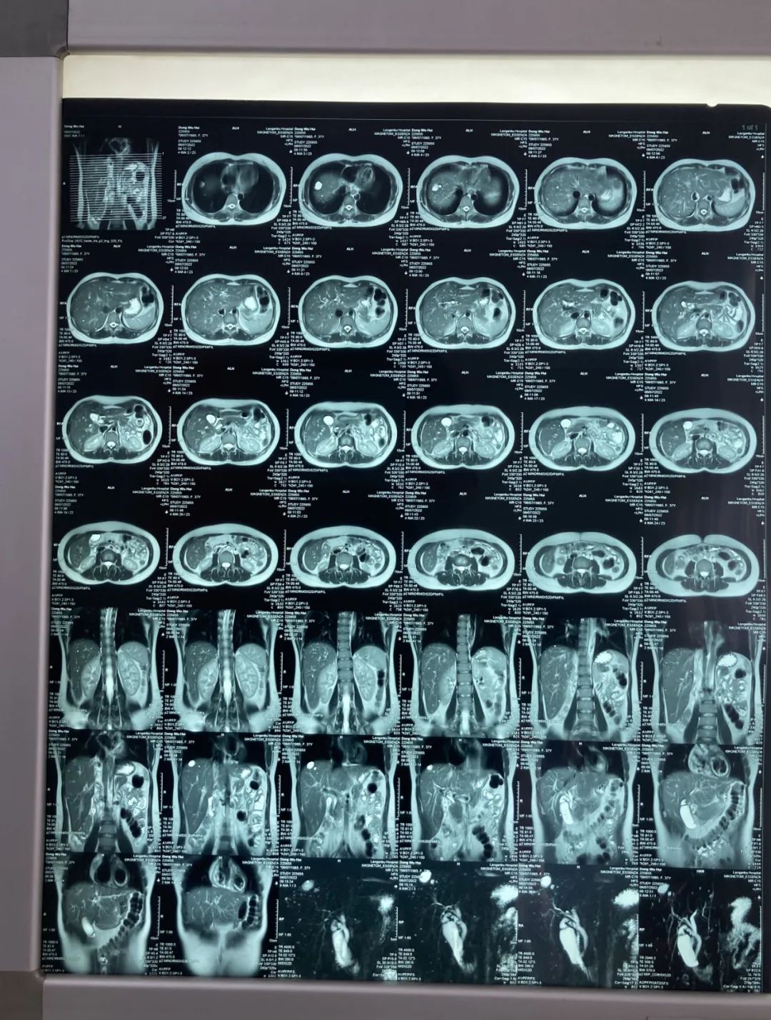 胆结石很小的时候医生说不用处理,胆结石不痛的情况下需不需要治疗