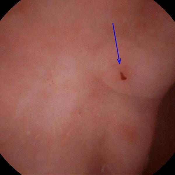 糜烂性胃炎一般多久能自愈好,慢性胃炎伴糜烂吃什么药可以自愈