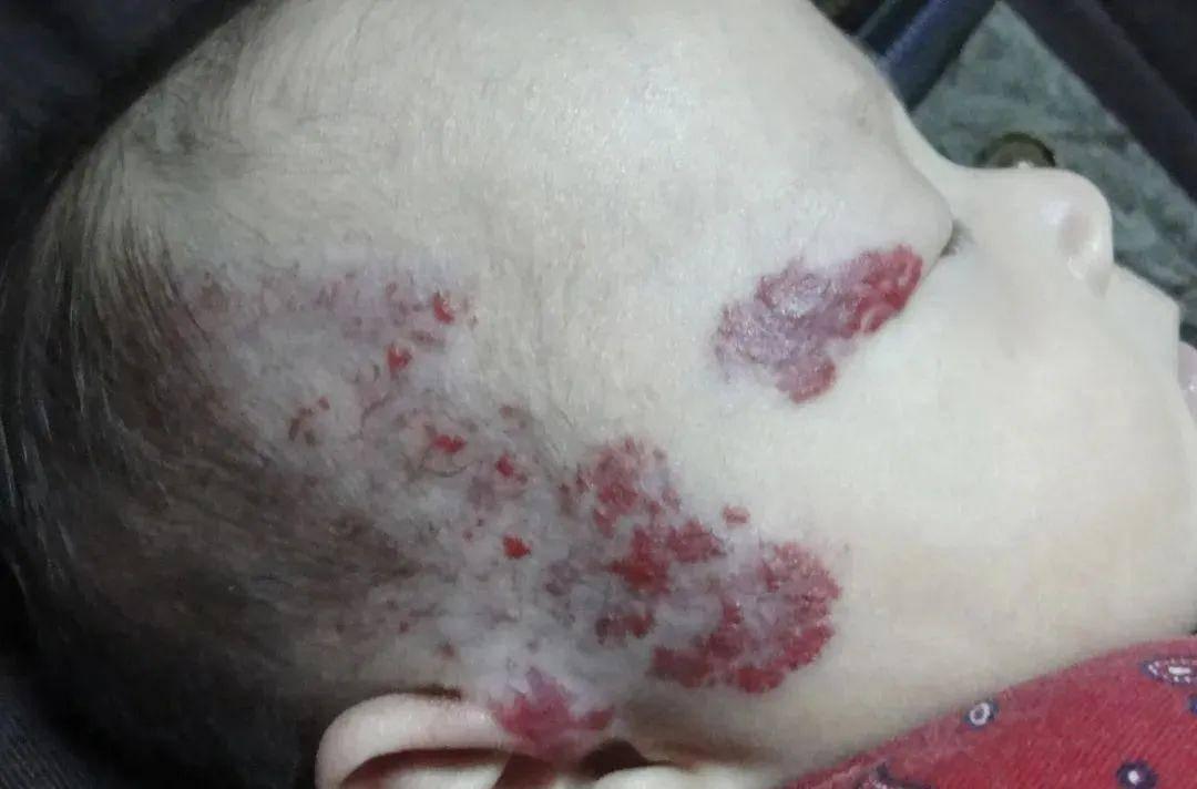 婴幼儿血管瘤会自行消退？小心长在这些部位的“瘤”，或危及生命
