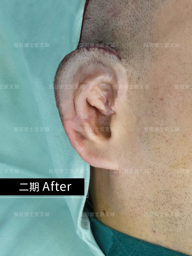 小耳畸形做耳再造哪位医生技术好,小耳畸形手术10年后效果图