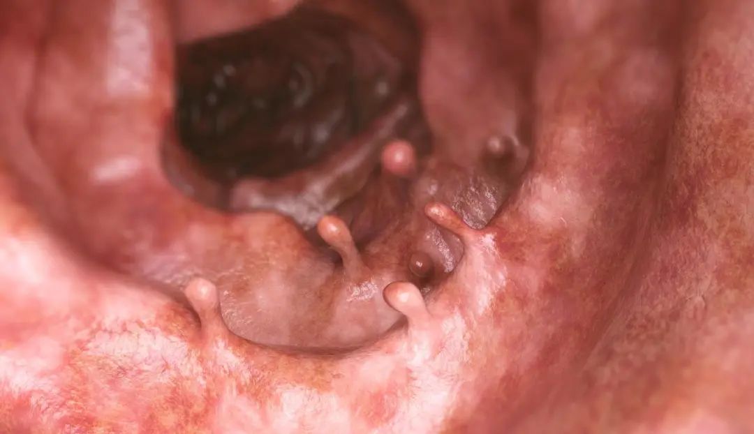 复旦肿瘤结肠癌,复旦大学肿瘤医院治结肠癌好吗