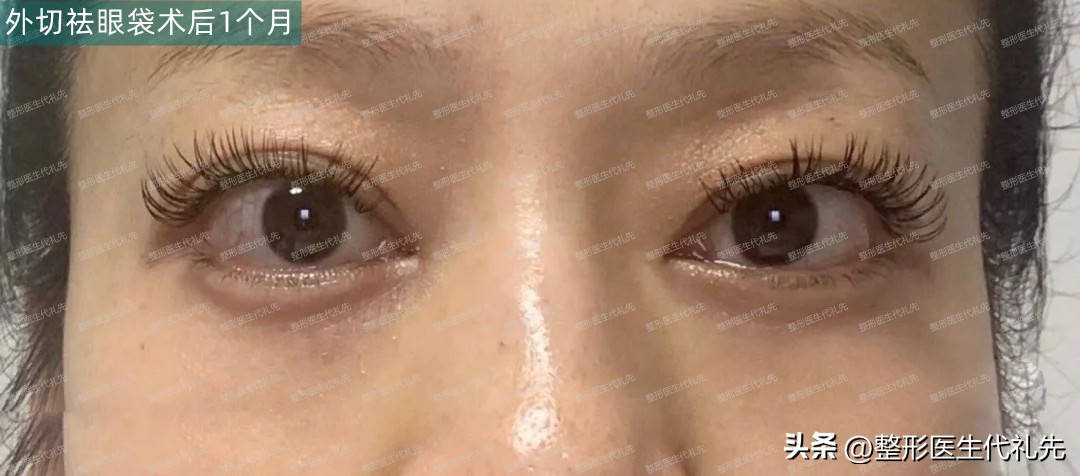 眼袋手术52天,眼袋手术27天了还用抹祛疤膏吗