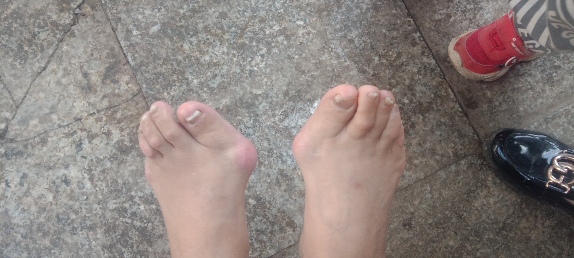 脚趾头关节骨头凸起,大脚趾拇外翻和正常脚对比