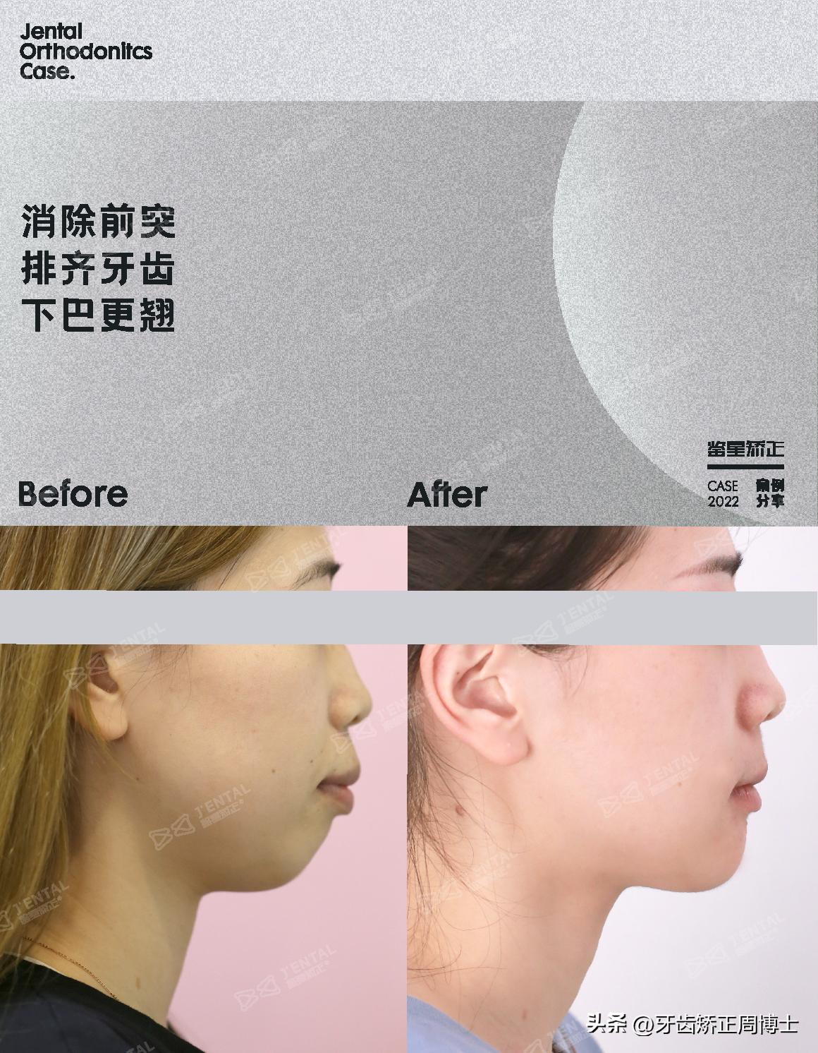 骨性前突正畸后多长时间有效果,牙性下巴后缩可以戴牙套改善吗