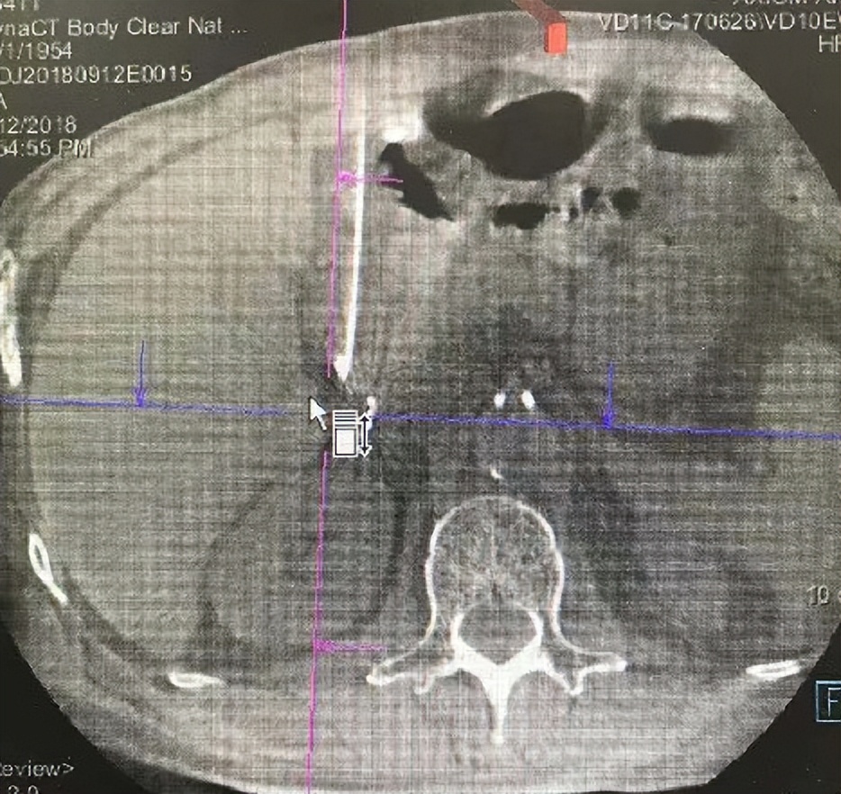粒子植入适合腹膜后淋巴结吗,腹膜后淋巴结转移化疗效果