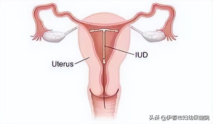 「健康科普」怎样避孕才最合理？