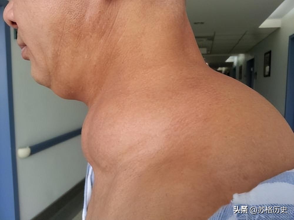 喝了40年酒结果变成河马脖,喝白酒脖子变成河马脖