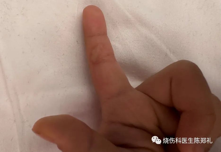 放烟花伤了人怎么办,鞭炮炸伤面部轻微怎么处理不留疤