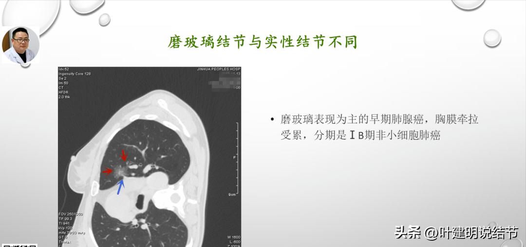 非小细胞肺癌精准检测ppt,关于肺癌的ppt