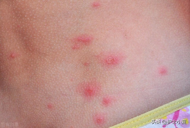 外阴瘙痒白带发黄右下腹痛已绝经,绝经以后外阴瘙痒