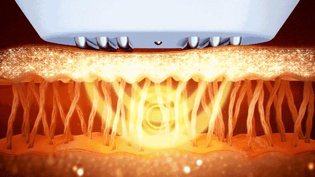 大腿上坑坑洼洼怎么办,大腿上坑坑洼洼的是什么原因