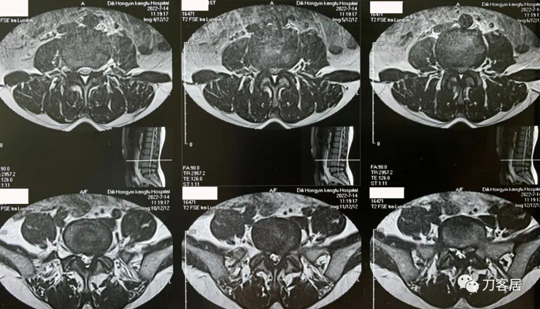 30岁女性左腿麻木是什么病的前兆,50岁的女人右腿经常麻是什么原因