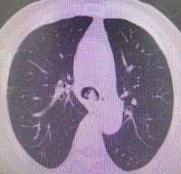 哈医大一院气管镜,哈医大群力呼吸内科