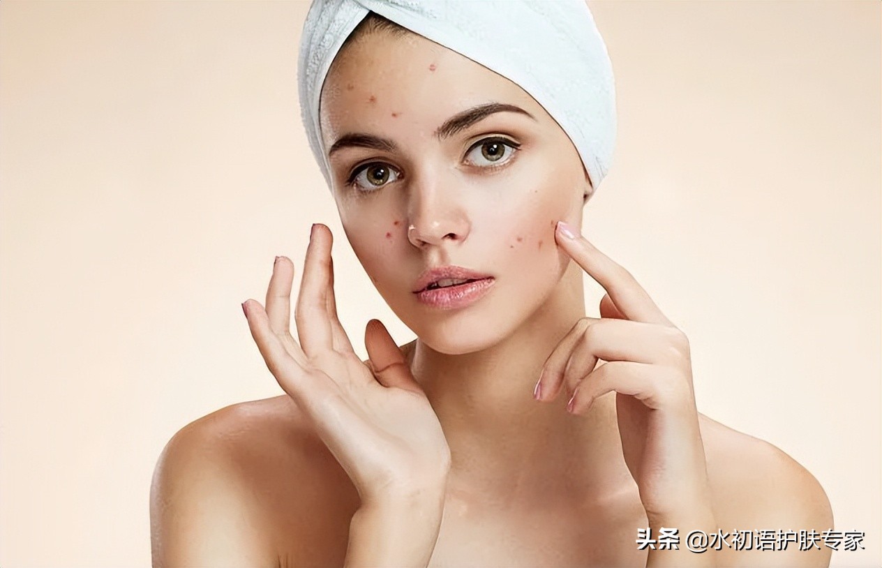 夏天容易长痘出油怎么办,夏日炎炎脸上开始爆痘怎么办