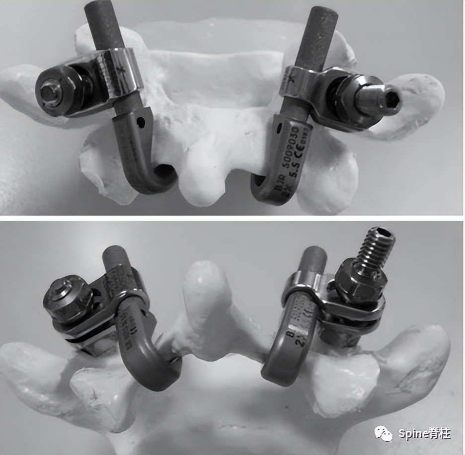 轻度峡部裂和重度峡部裂的区别,真性峡部裂和假性峡部裂