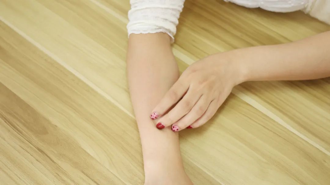 荨麻疹跟蚊虫叮咬的区别,蚂蚁咬过敏全身荨麻疹用什么药