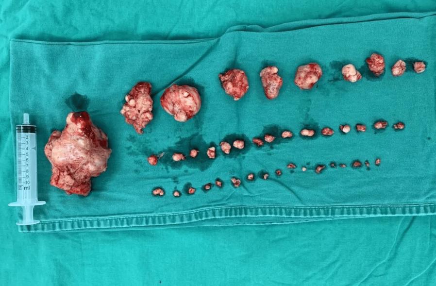 10年没治疗，子宫肌瘤长到4斤，如6个月的婴儿！手术取出109颗