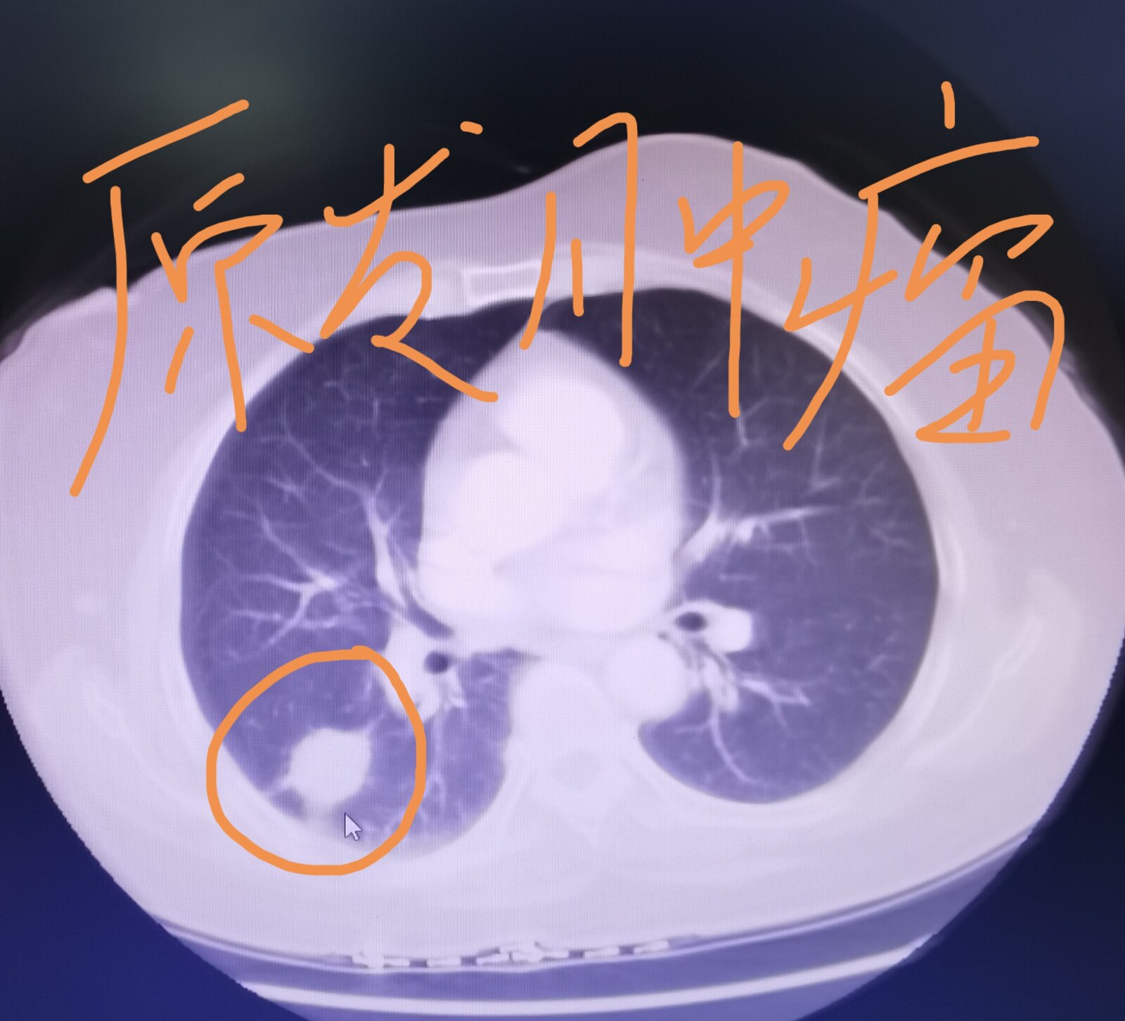 刘懿博士说肺癌,刘懿博士谈肺癌脑转移