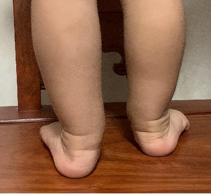 1岁宝宝不愿走路总是要爬怎么办,2岁宝宝一只脚扁平足怎么办