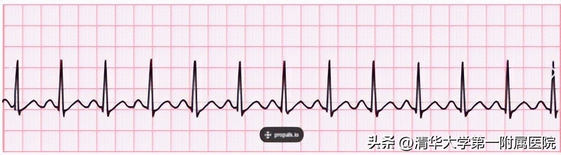 体检心电图报告解读,美年大体检心电图报告