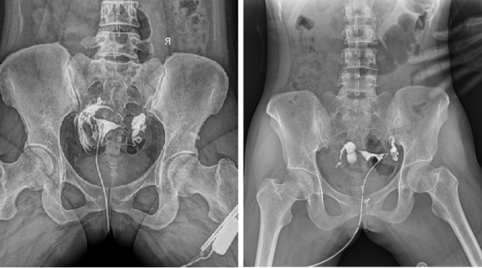 三维子宫输卵管超声造影临床应用,输卵管造影dr检查有辐射吗