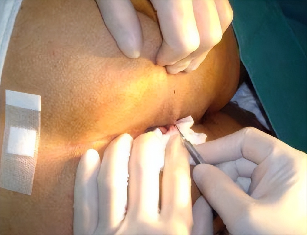 肛门有小肉疙瘩怎么治疗,肛门长小肉疙瘩怎么治疗