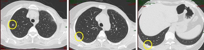 乳腺癌晚期没多少钱怎么治疗最佳,经济困难癌症晚期可以放弃治疗吗