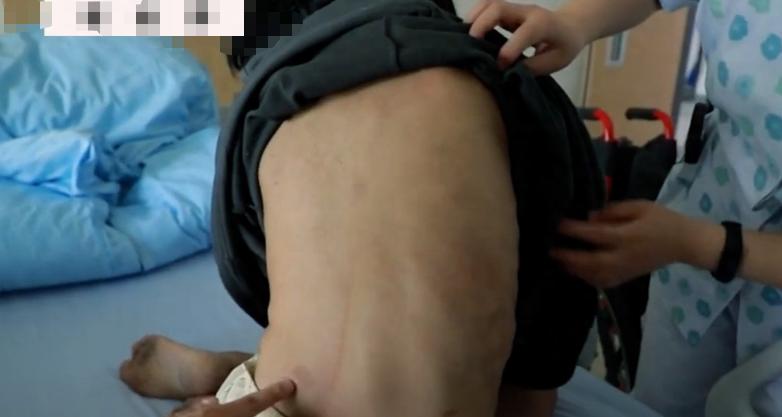 女孩体内4000多肿瘤,女孩体内上千肿瘤结果怎么样了