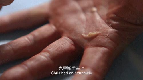 他得了什么病,他得的什么病