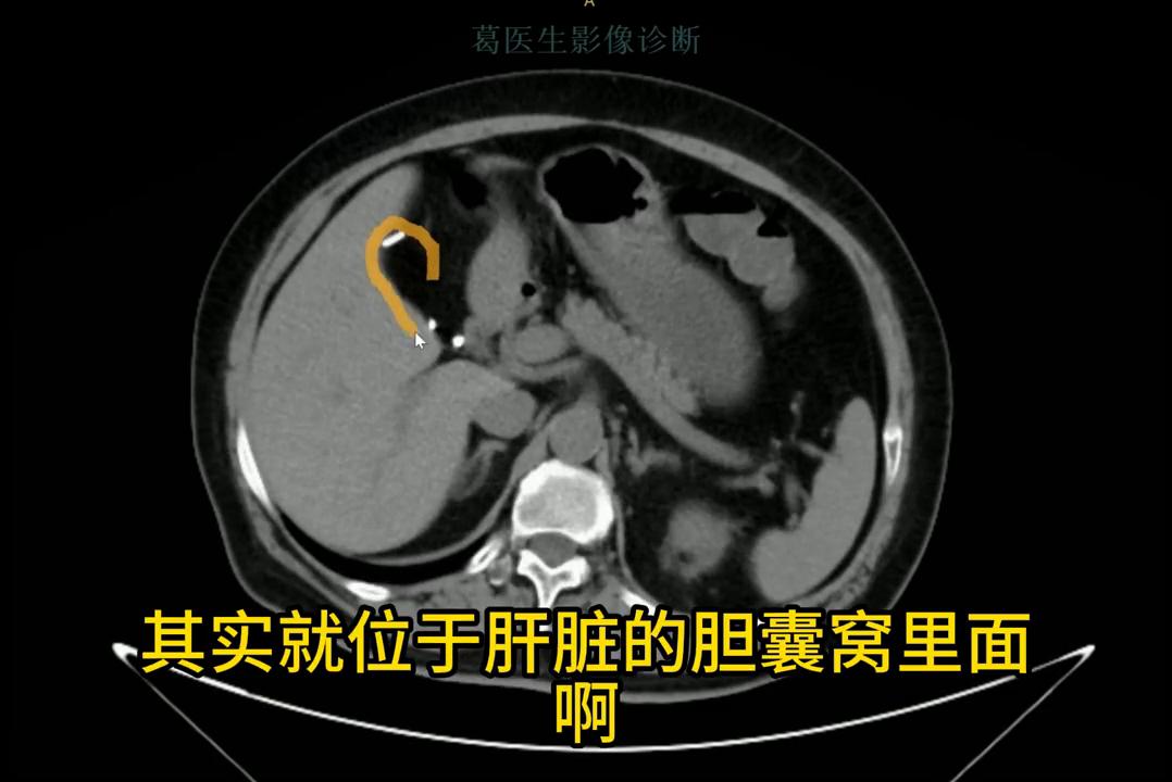 腹部ct影像解剖图谱,腹部ct阑尾影像