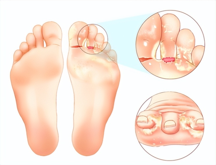 脚气到底是怎么引起的,脚气是怎么引起的用什么药治疗
