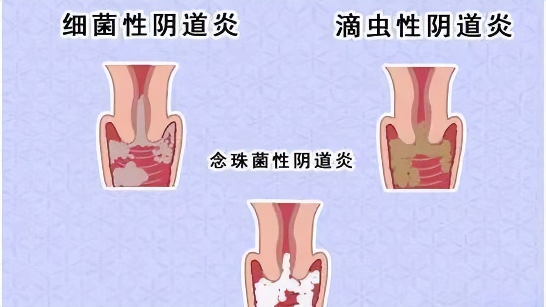 为什么月经结束后出现褐色分泌物,月经结束后有褐色分泌物怎么办