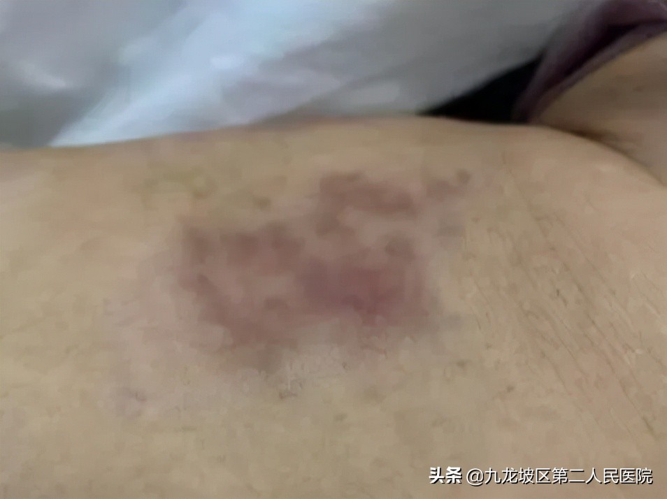58岁阿姨臀部长疱疹，医生用火针放血、隔物灸疗居然治好