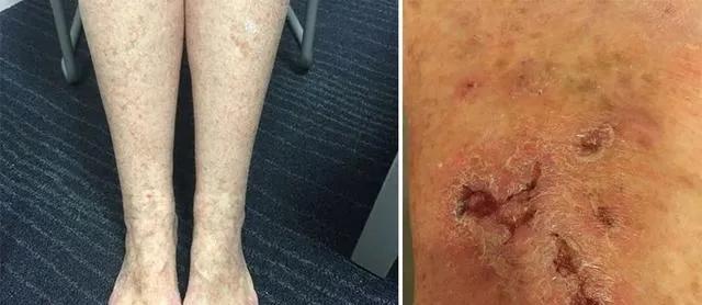 青斑血管病可以治愈吗,青斑是皮肤病还是血管病