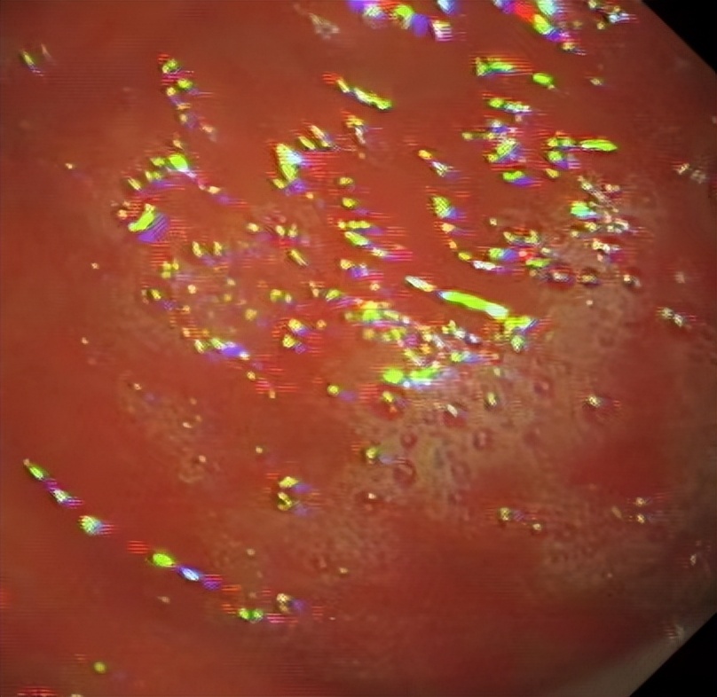 胃片怎么拍,胃造影的流程